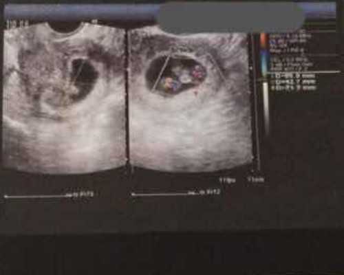 长沙供卵成功率高,2024长沙三代试管生男孩价格及费用明细一览